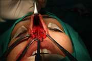 جراحی رینوپلاستیی یا جراحی بینی 